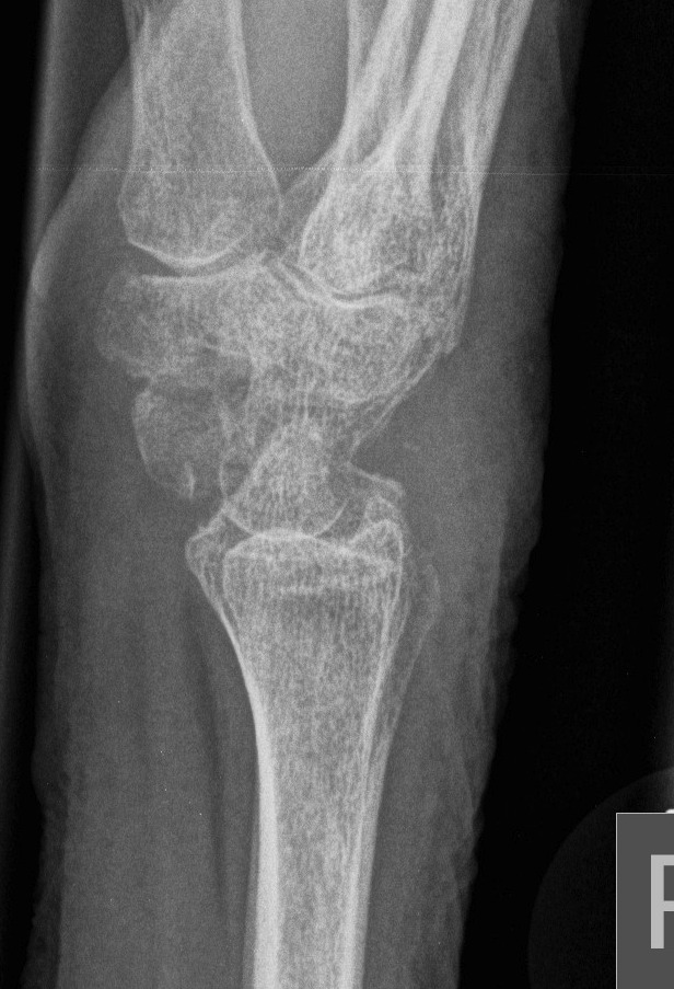 Proximal Row Carpectomy Lateral